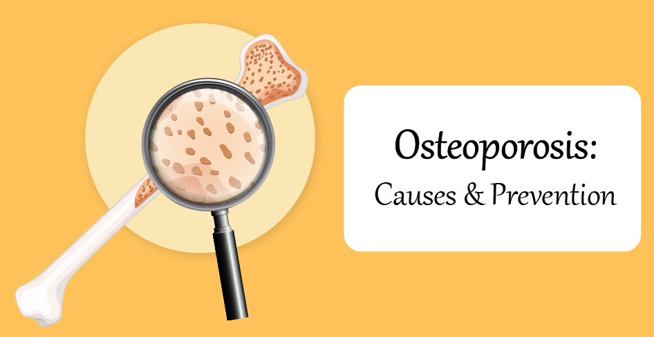 Osteoporosis - Causes and Prevention